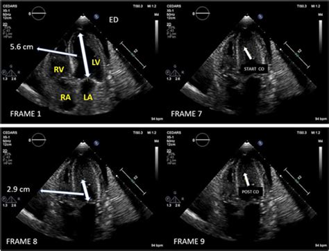 left ventricular cavity obliteration